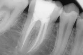 Endodonzia radiografie