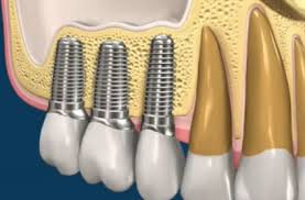 protesi dentali rimovibili